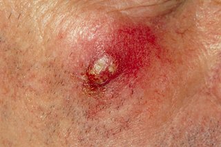 A boil on the skin