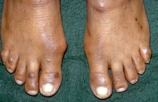 Brown feet with hard lumps on the side of the feet at the base of the big toes