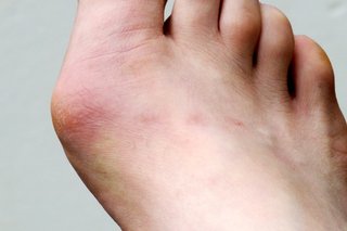 Right foot with lump at base of big toe and the skin looks hard and red