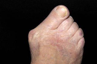 Right foot with lump at base of big toe and the big toe is pointing in towards the other toes