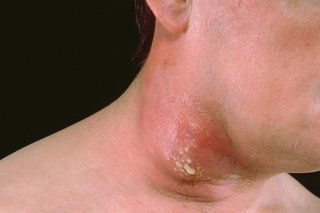A cluster of pus-filled boils on a man's neck.