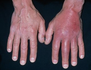 two hands side by side, with the backs of the hands facing up. One hand is red and swollen and the other hand is not.