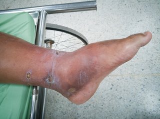 Foot with white skin. The top of the foot is red and swollen.