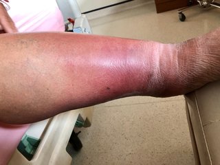 Lower part of an older person's leg is red and swollen.