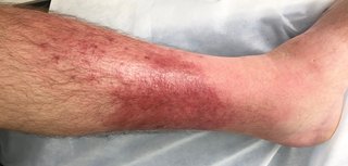 lower leg with red and swollen skin