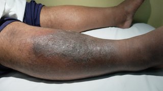 Lower leg with brown skin. There is swelling, darker areas of skin and scaling across the shin and lower leg.