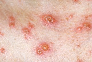 Chickenpox blisters with scabs on white skin.