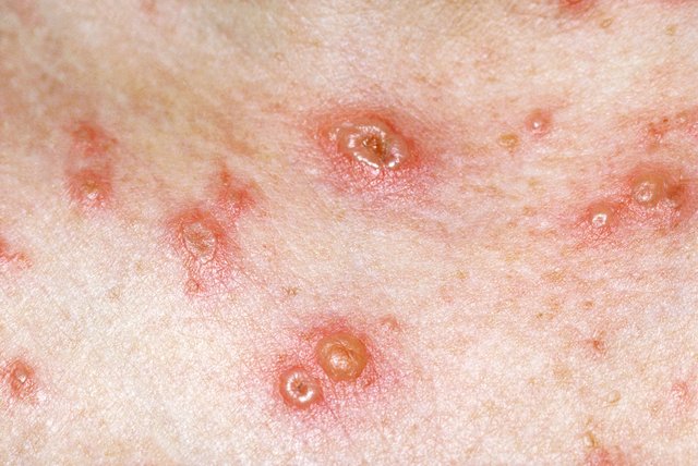 Chickenpox