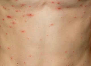 Red spots on white skin that are set apart from each other and small in size.
