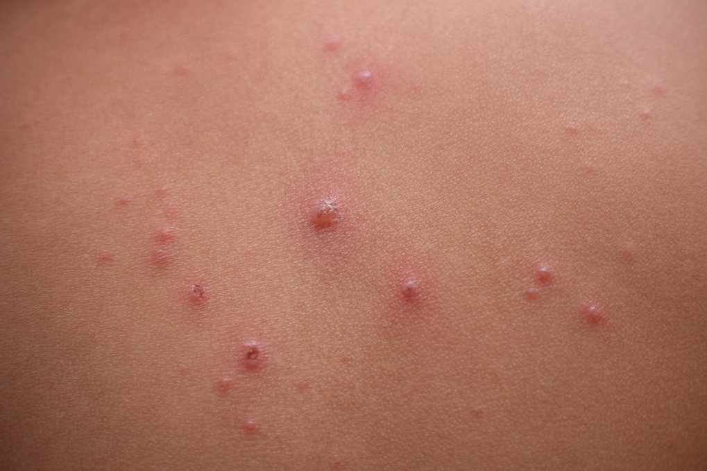 Chickenpox