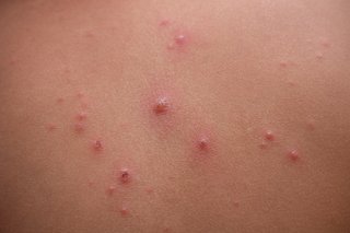 Small spots fill with fluid forming blisters. Shown on white skin.