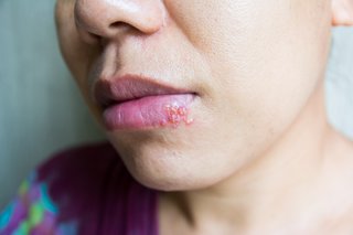 Close up of a mouth with a cold sore scab on the lower lip