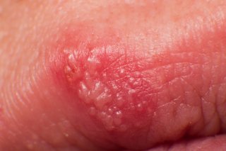 Close up of a mouth with a cold sore blister on the lower lip