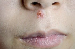 Close up of a face with a cold sore blister between the nose and mouth