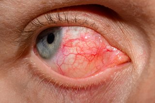 A red and gritty eye caused by conjunctivitis.