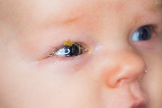 A baby with sticky pus and yellow crusts on their eyelashes.