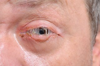 A sticky eye producing pus caused by conjunctivitis.