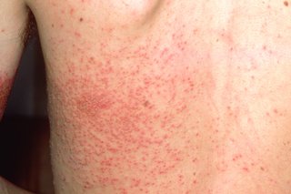 lots of small red dots on white skin