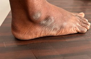 Grey patches of rough, thick skin on the side of a foot, shown on black skin.