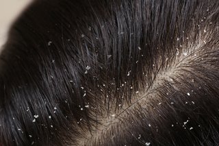Close up of white dandruff flakes on brown hair.