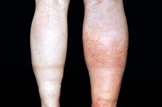 The calf of the right leg is red and swollen. The calf of the left leg is white and is not swollen