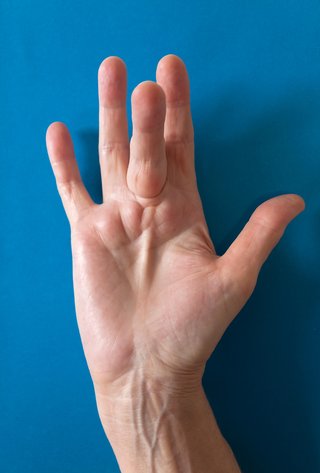 The palm of a hand with white skin held out flat with the middle finger sticking upwards and raised lumps along the palm below it.