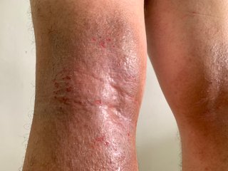 backs of the knees of a person with brown skin and inflamed skin that is grey