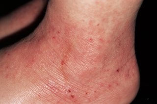 ankle of a person with white skin and inflamed skin that is red