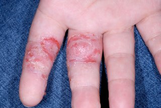 patches of cracked, red skin on two fingers of a white hand