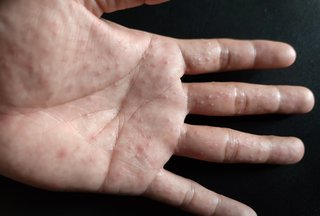 the palm and fingers of a white hand covered with small spots