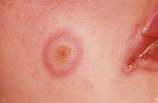Target lesions of erythema multiforme on the face with white skin.