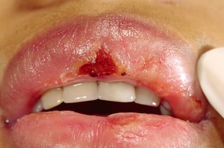 A crusted, bleeding sore on the top lip of someone with erythema multiforme on their mouth