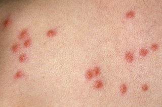 A cluster of flea bites shown on white skin. They are red raised bumps.