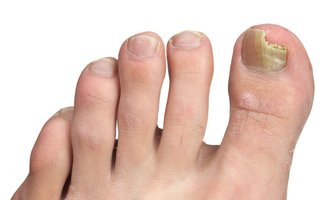 The nail on a person's big toe is yellow and crumbling. Part of the big toe nail has broken off.