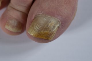 The nail on a big toe has turned yellow.