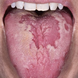 photo of a tongue with blotchy, red patches and a white patch