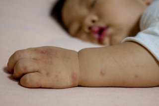 Red spots on a child's arm and hand