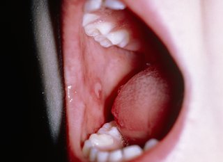 Ulcers on a child's tongue