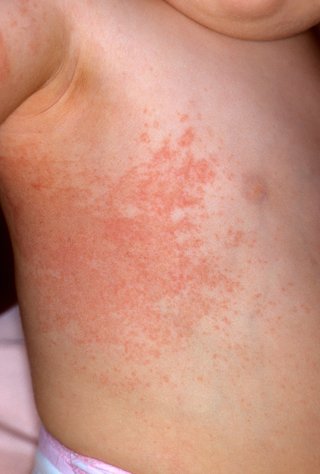 White skin mostly covered with tiny red spots that are close together.