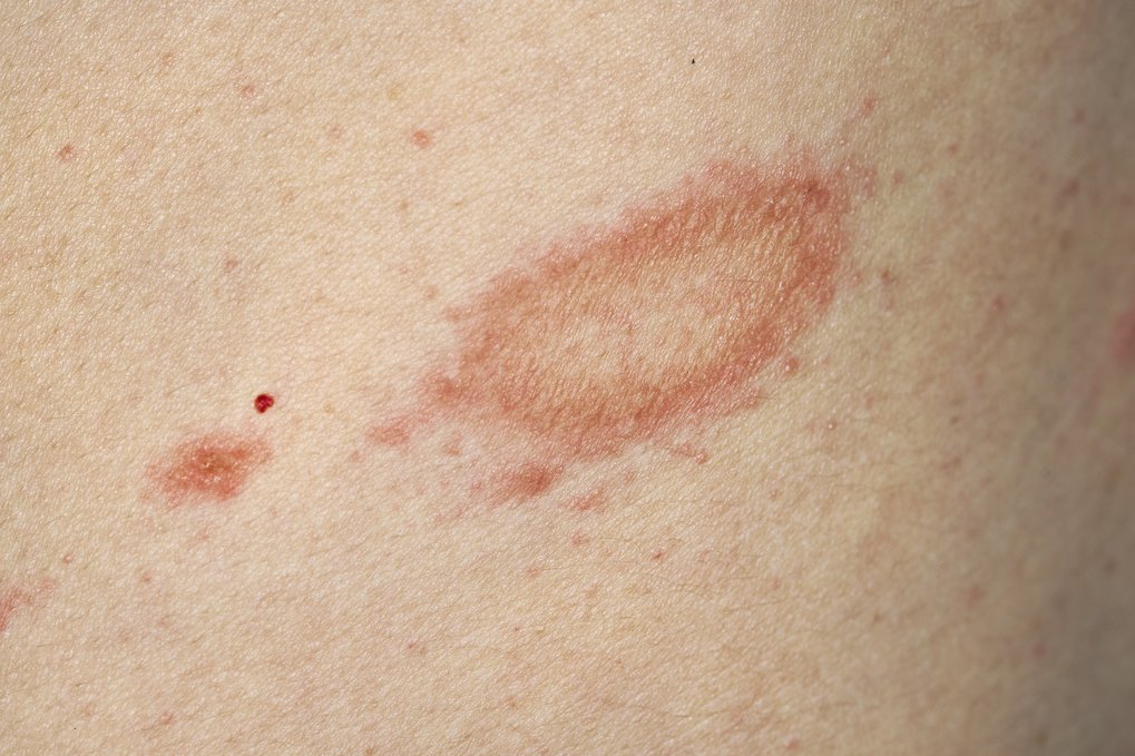 Pityriasis rosea: symptoms, causes, diagnosis and treatments