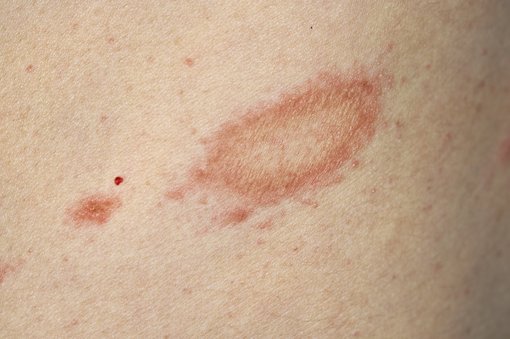 Pityriasis rosea: symptoms, causes, diagnosis and treatments