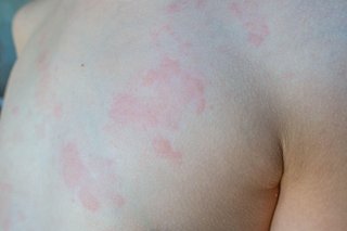 A child with light brown skin and the hives rash on their leg and hip.