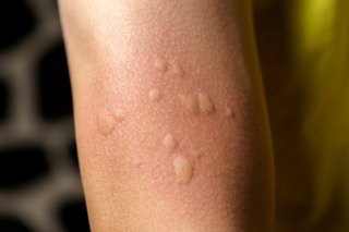 Light brown skin with small skin-coloured bumps from hives