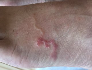 A large, dark pink hookworm underneath a person's skin