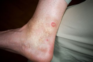 A horsefly bite shown on white skin. There is a round red area where the skin was bitten.