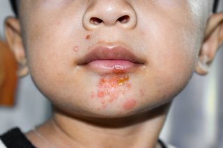 Lower face of a child with a red crusty sore on their nose and yellow-white blisters around their lips, shown on white skin.