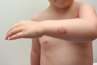 A red and golden crusty patch on the arm of a young child, shown on white skin.