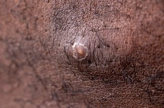 An infected ingrown hair with pus in the centre of the spot, shown on black skin.