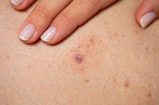 An infected ingrown hair with pus in the centre of the spot, shown on white skin.