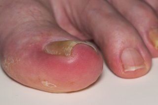 Ingrown nail on a big toe that is red and swollen, shown on white skin.
